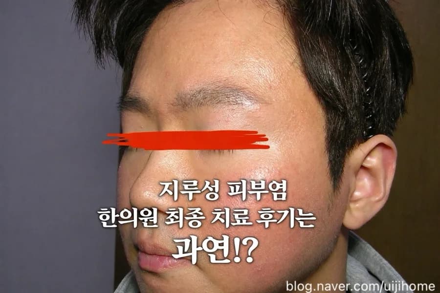 지루성 피부염 한의원 치료 9개월 후기: 증상 변화와 솔직한 경험 2026