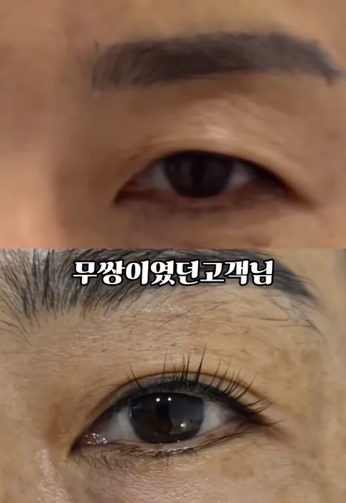 눈꺼풀 리프팅, 레이저 없이 자연스러운 효과 2026년 최신 정보