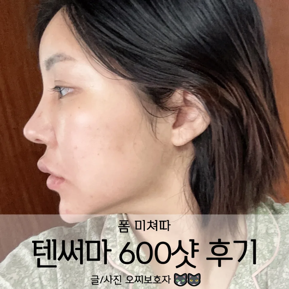 강남구청역 텐써마 600샷 통증 적은 후기 2026