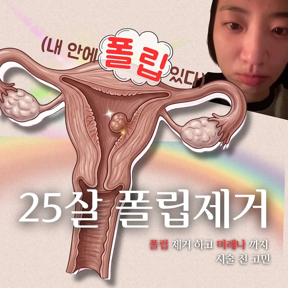자궁 폴립 제거 및 미레나 시술 후기 (2026년 최신 정보)