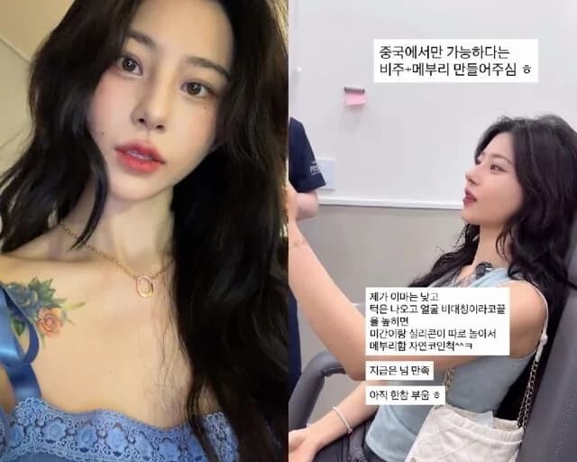노슬비 코 성형 후기 2026: 붓기 관리와 솔직한 심경 변화