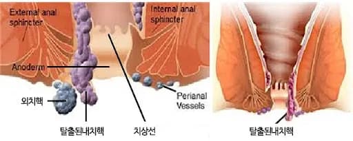 치질 수술 보험 보장 범위 2026년 총정리: 실비만으론 부족한 이유