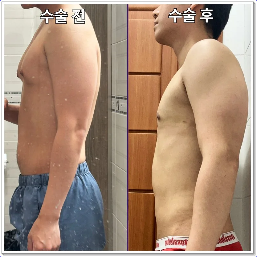 여유증 주사 치료, 정말 가능할까? 2026년 전문가 분석